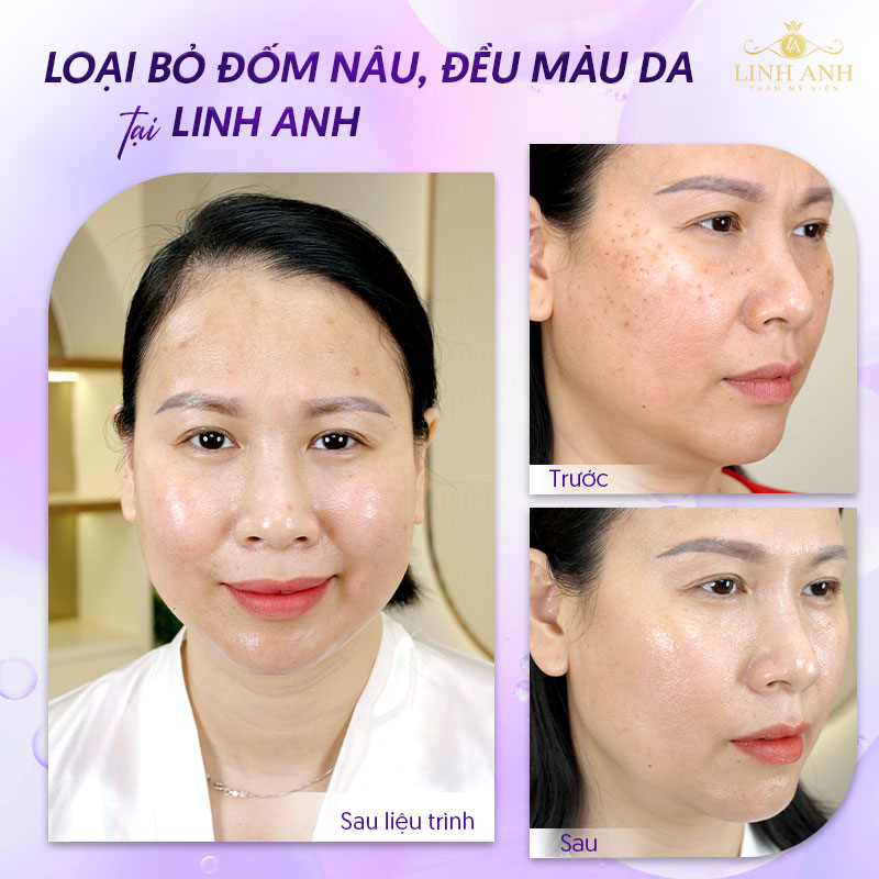 Điều trị nám tàn nhang đồi mồi tại Linh Anh
