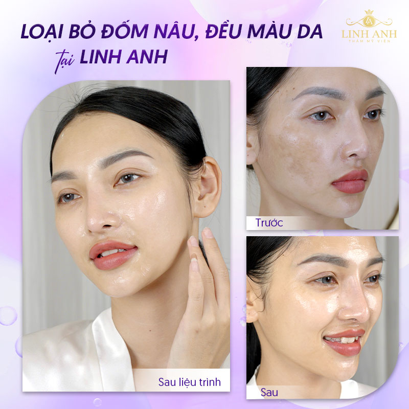 Trị nám tàn nhang và đồi mồi thành công