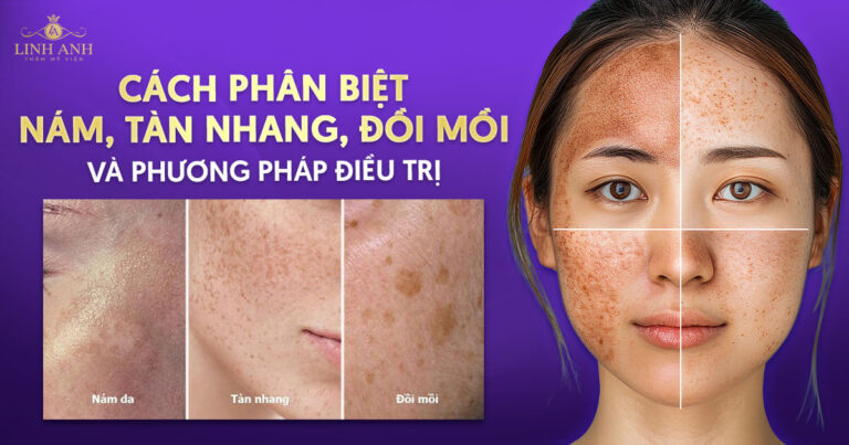 Phân biệt nám tàn nhang và đồi mồi