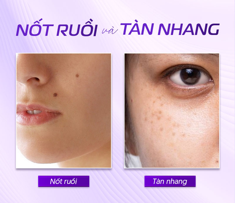 nốt ruồi và tàn nhang