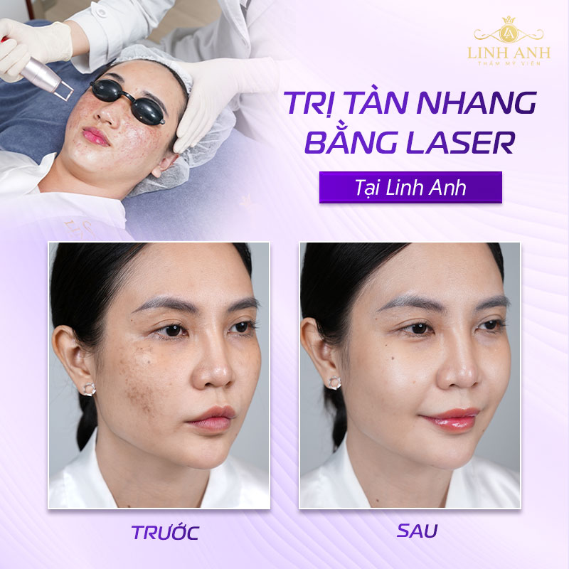 điều trị tàn nhang