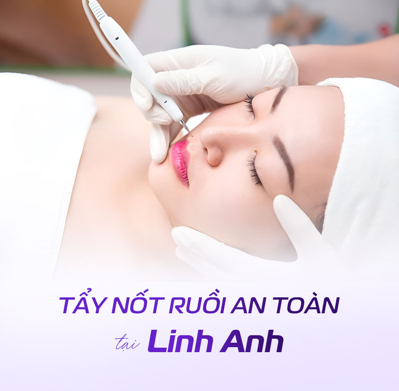 tẩy nốt ruồi