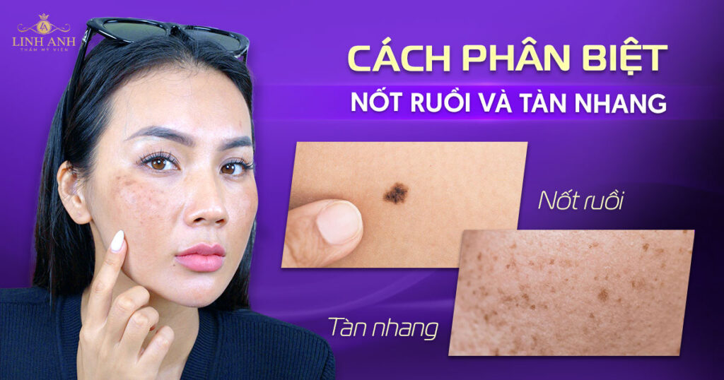 phân biệt nốt ruồi và tàn nhang