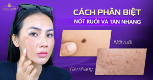 phân biệt nốt ruồi và tàn nhang