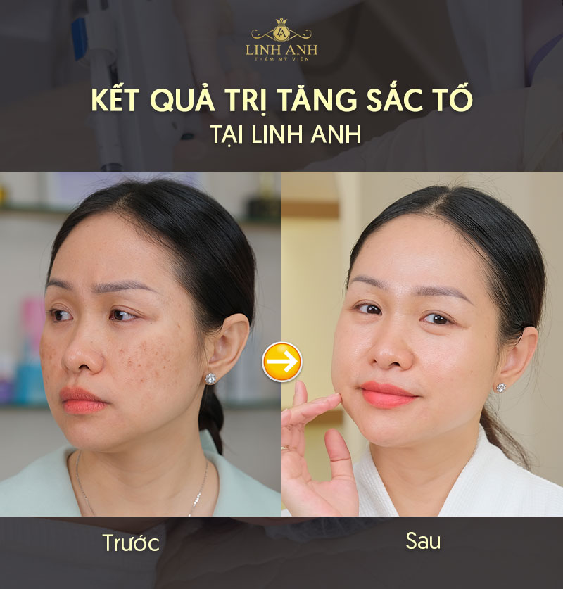 Điều trị rối loạn sắc tố da tại Linh Anh