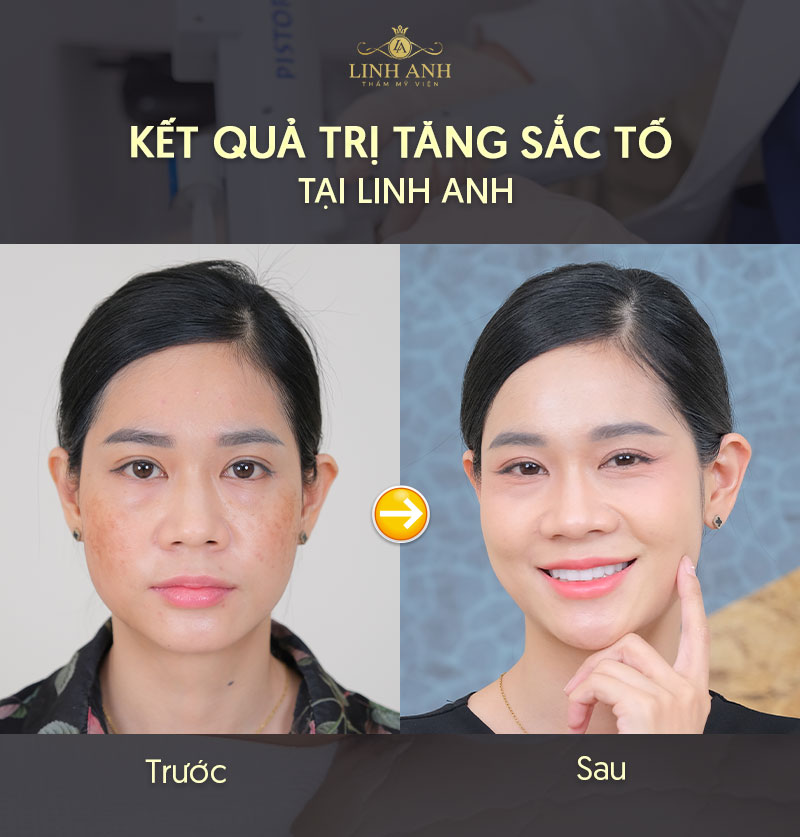 Kết quả trị liệu rối loạn sắc tố da tại Linh Anh