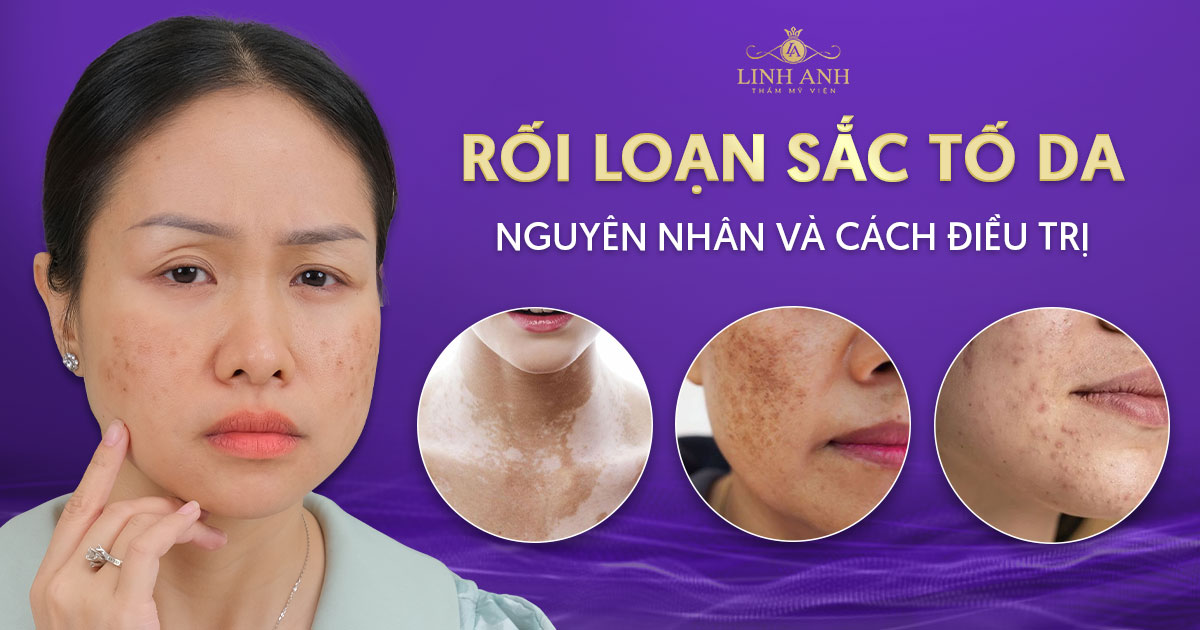Rối loạn sắc tố da và những cách điều trị hiệu quả