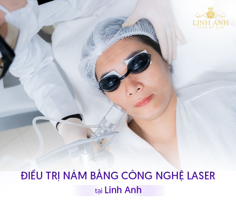 Điều trị nám bằng công nghệ cao