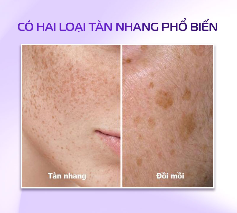 Tàn nhang là gì