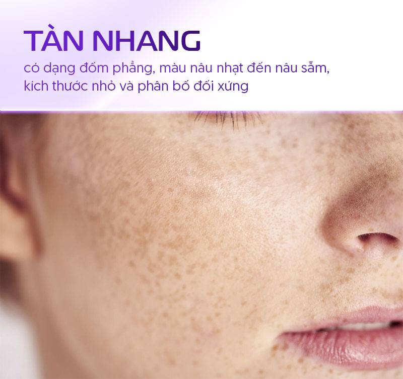 Dấu hiệu da tàn nhang