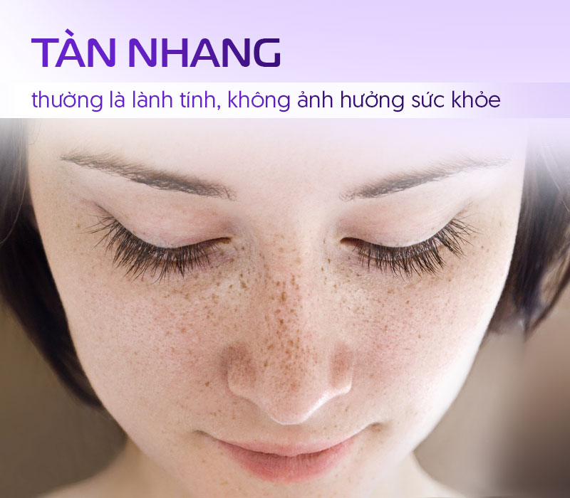 Mặt tàn nhang có ảnh hưởng sức khỏe không