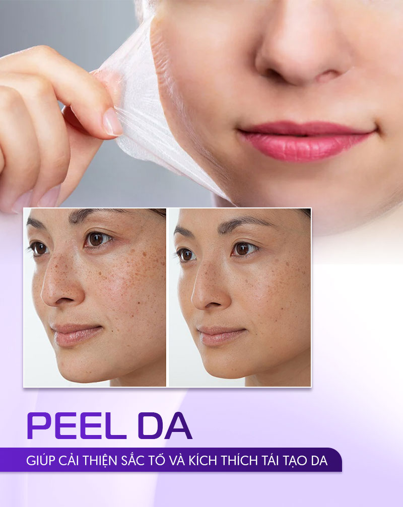 Peel da trị tàn nhang ở mặt