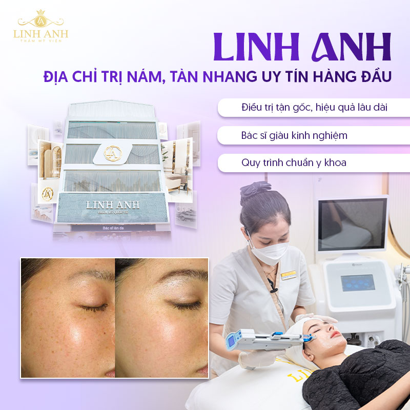 Điều trị tàn nhang tại Linh Anh