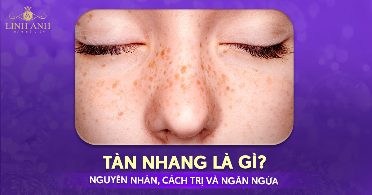 Tàn nhang là gì? Tìm hiểu nguyên nhân, cách trị và ngăn ngừa