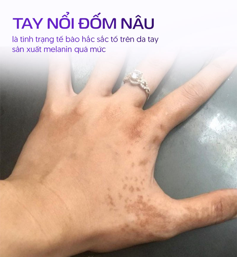 tay tự nhiên nổi đốm nâu trên da