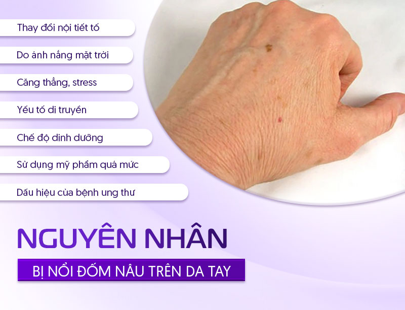 tay bị nổi đốm nâu