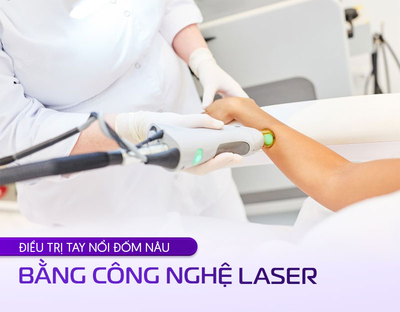 trị đốm nâu bằng công nghệ laser