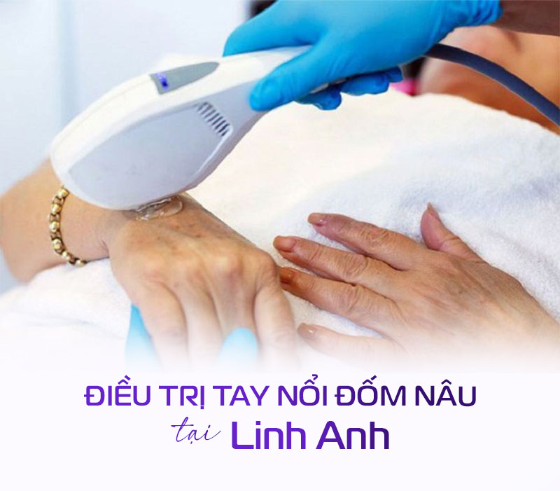 điều trị tay bị đốm nâu
