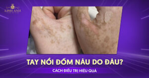 tay nổi đốm nâu