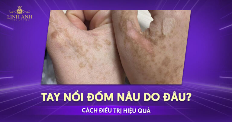 Tay nổi đốm nâu do đâu? Nguy hiểm không và điều trị thế nào?