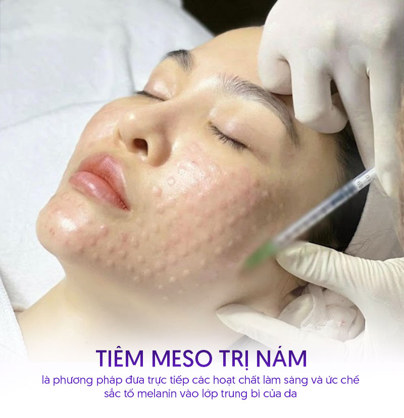 Tiêm meso trị nám là gì