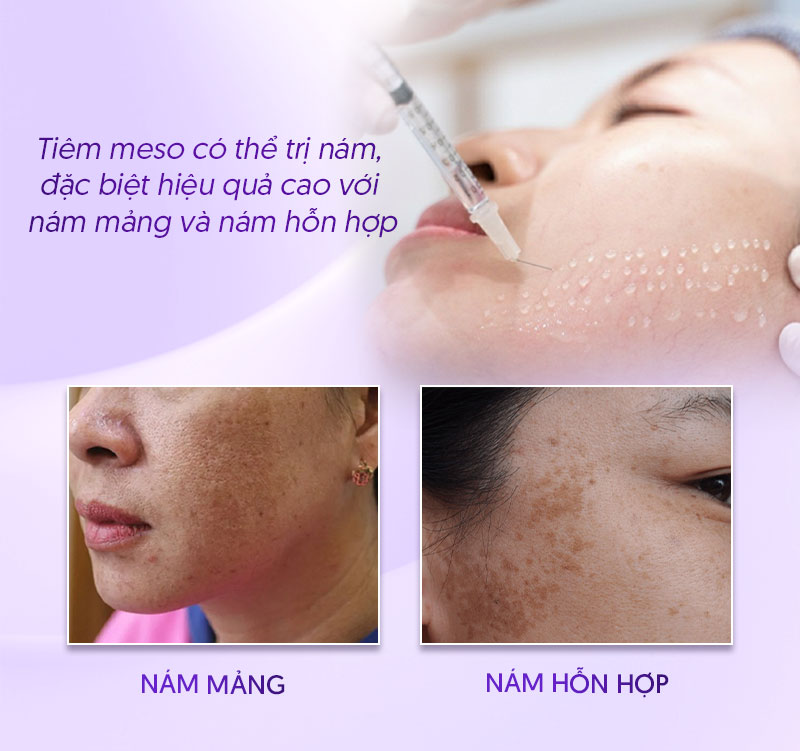 Tiêm meso trị nám có tốt không