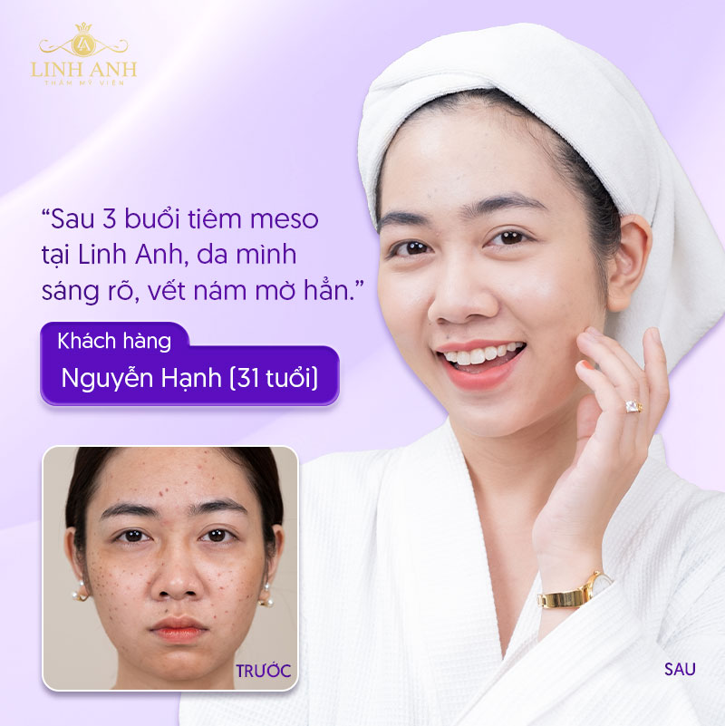 Khách hàng Mỹ Hạnh tiêm nám tại Linh Anh