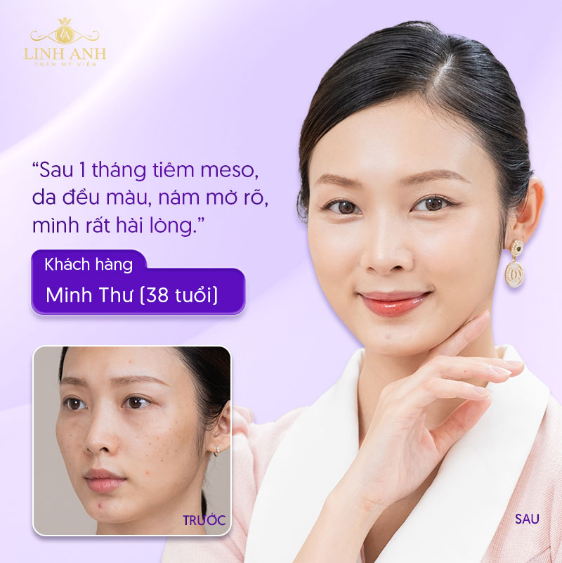 Khách hàng Minh Thư trị nám tại Linh Anh
