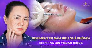 Tiêm meso trị nám