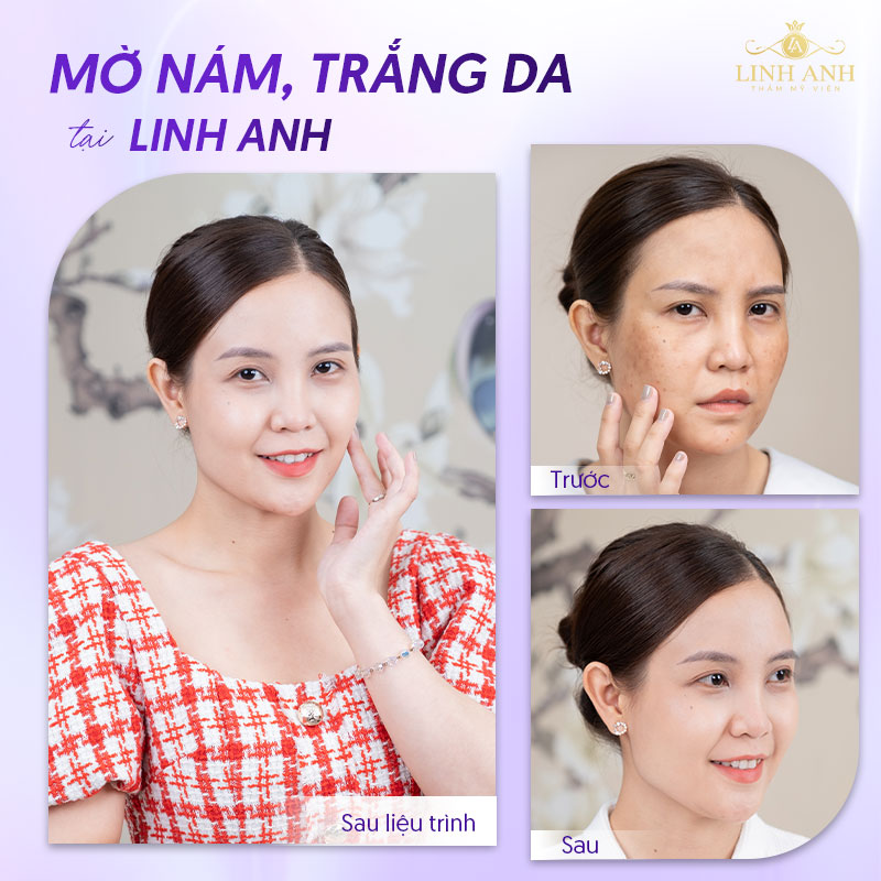 Trị nám da tại Linh Anh