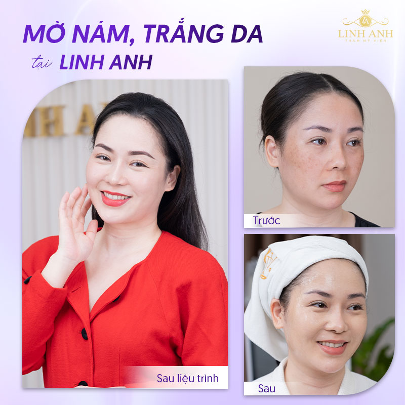 Hiệu quả điều trị nám da tại Linh Anh