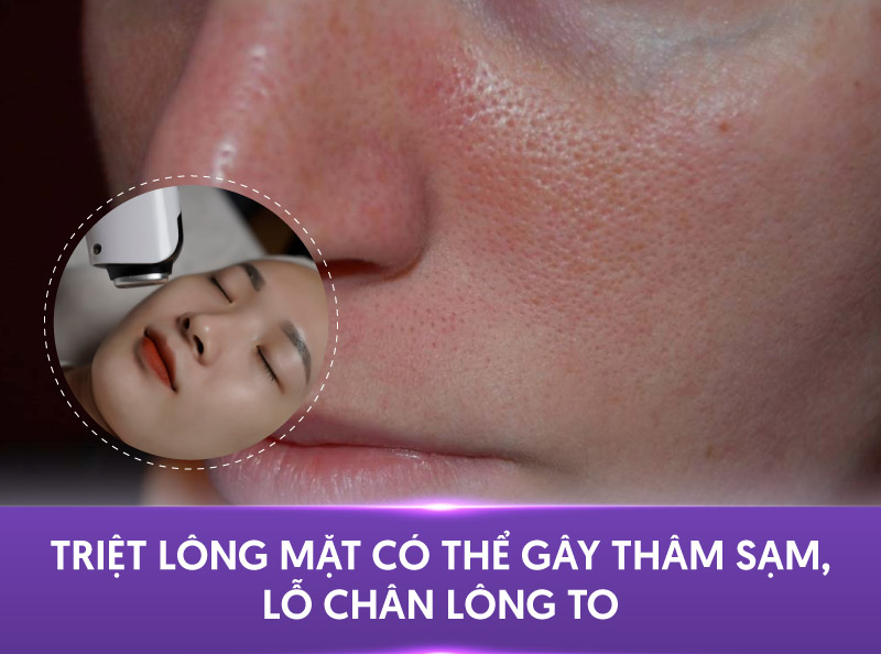 triệt lông mặt có hại không triệt lông mặt có hại không