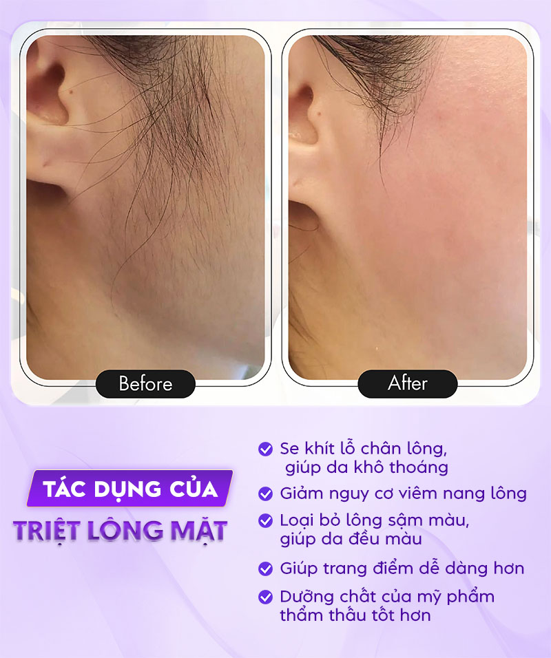 triệt lông mặt có tốt không triệt lông mặt có tốt không