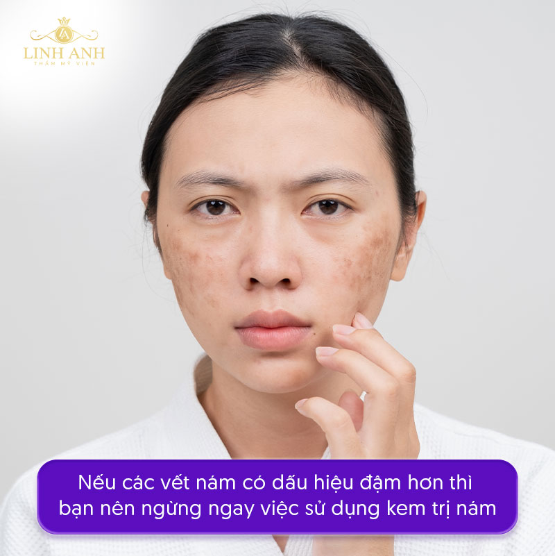 Nám sạm da đậm hơn do dùng kem nên làm gì