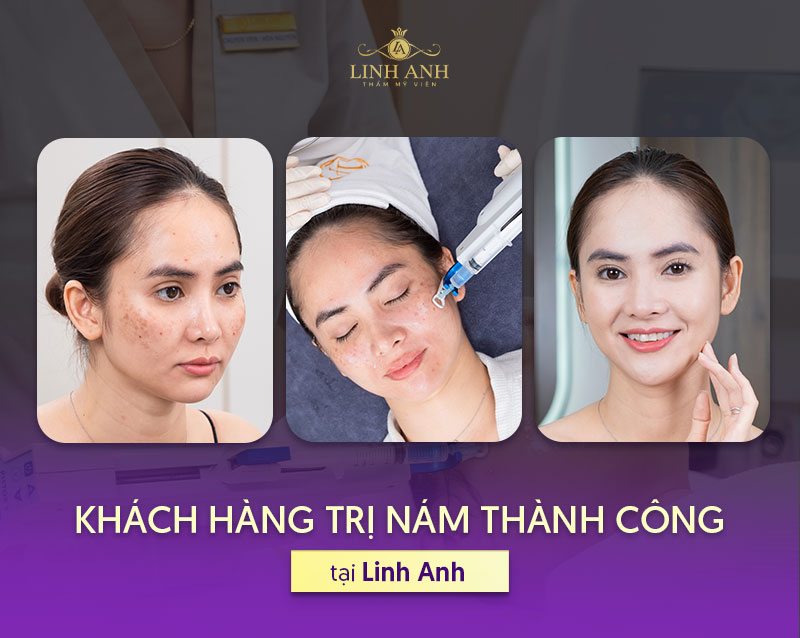 Khách hàng trị nám tại Linh Anh