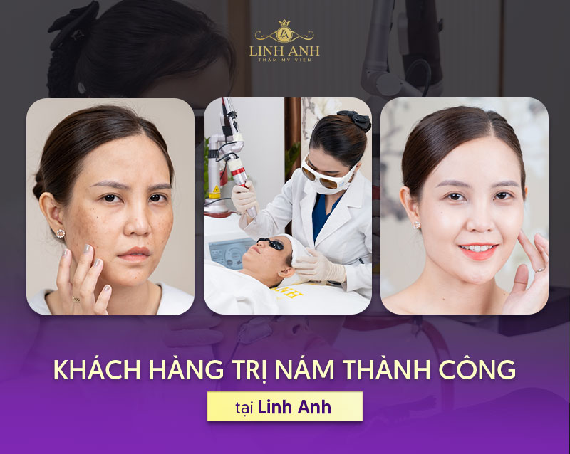 Trị nám thành công tại Linh Anh