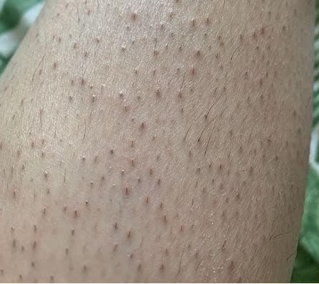 Hình ảnh lông mọc ngược ở chân