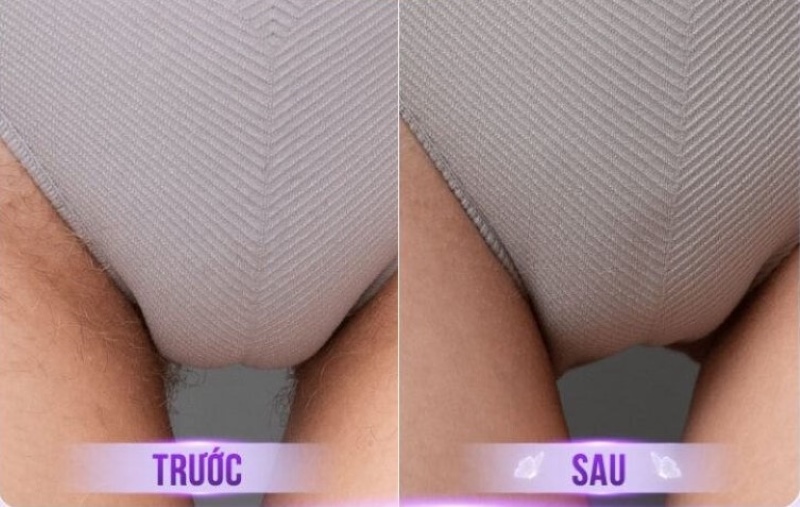 ảnh trước/ sau khi triệt lông vùng kín