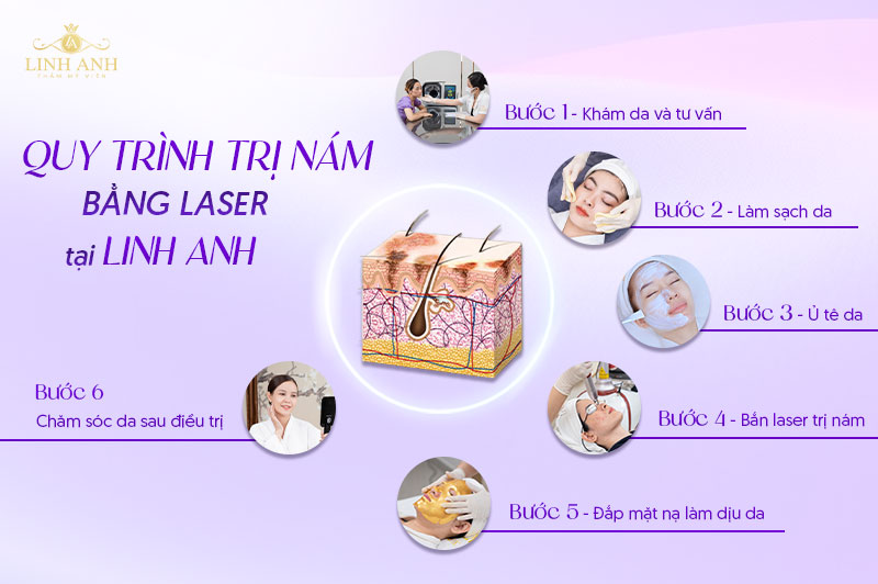 bắn nám bằng laser