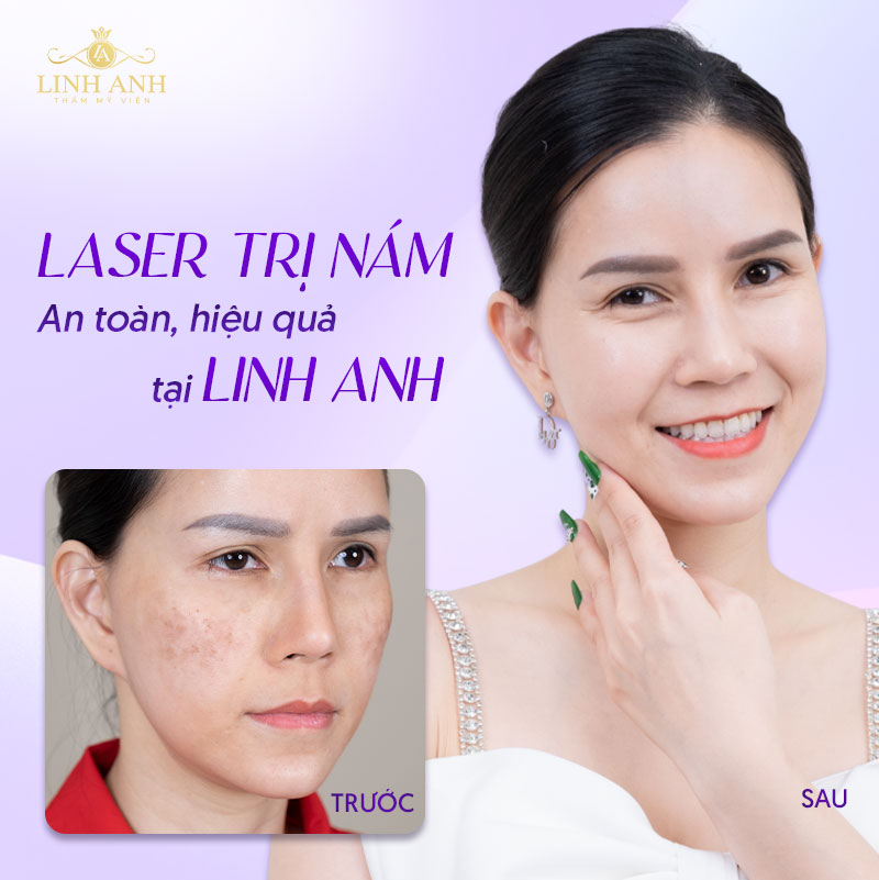 xóa nám bằng laser
