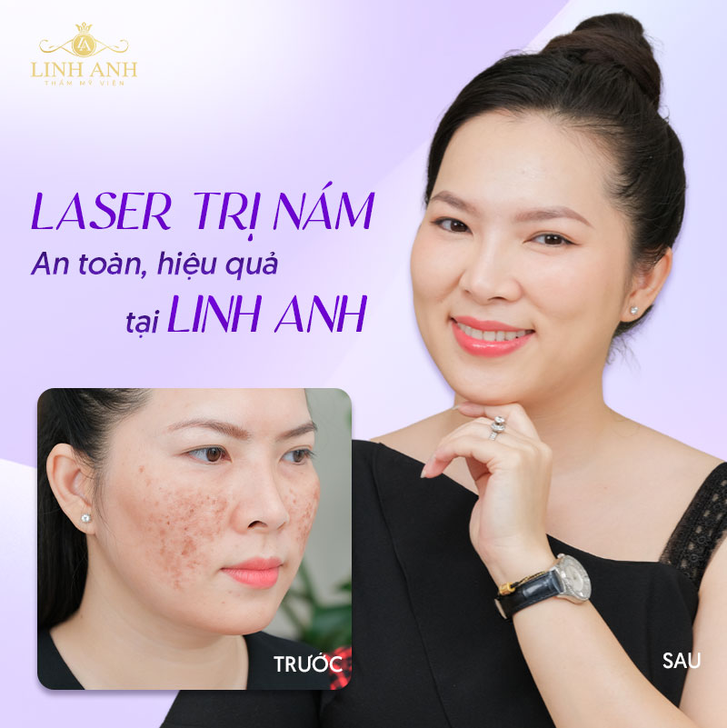 khách hàng trị nám bằng cách bắn laser