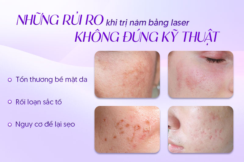 bắn laser trị nám có tốt không