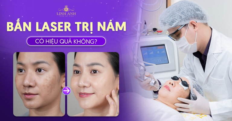 Bắn laser trị nám có hiệu quả không? Bắn 1 lần bao nhiêu tiền?