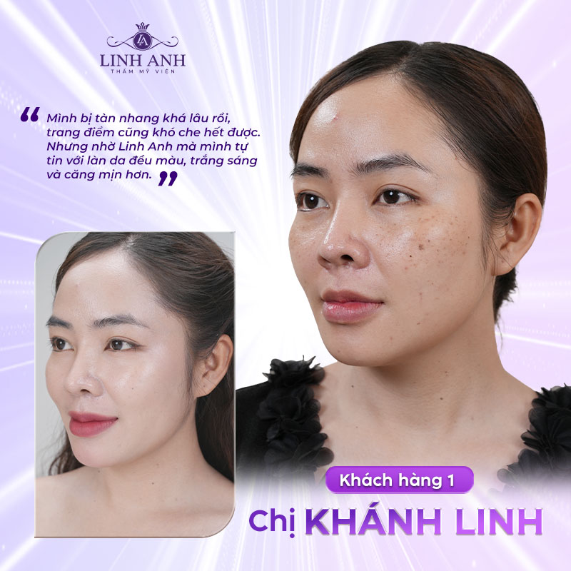 bắn laser tàn nhang bao lâu thì bong