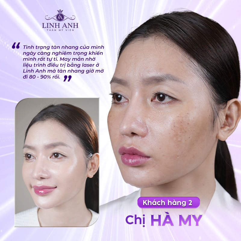 trị tàn nhang bằng laser