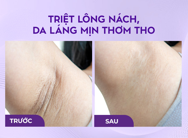 bảng giá triệt lông ở bệnh viện da liễu bảng giá triệt lông ở bệnh viện da liễu