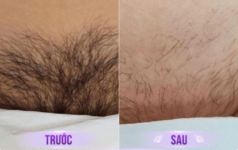 before và after triệt lông bikini