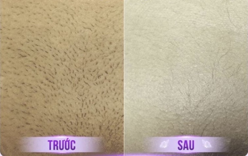before và after triệt lông vùng kín