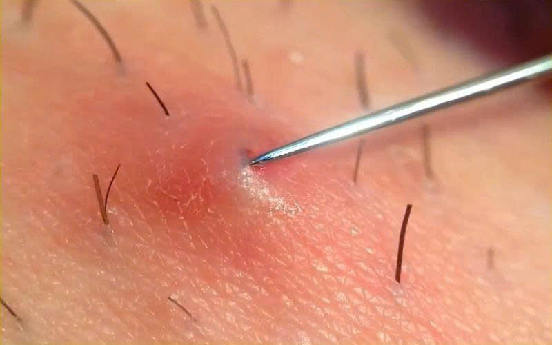 Cách chữa lông mọc ngược Cách chữa lông mọc ngược
