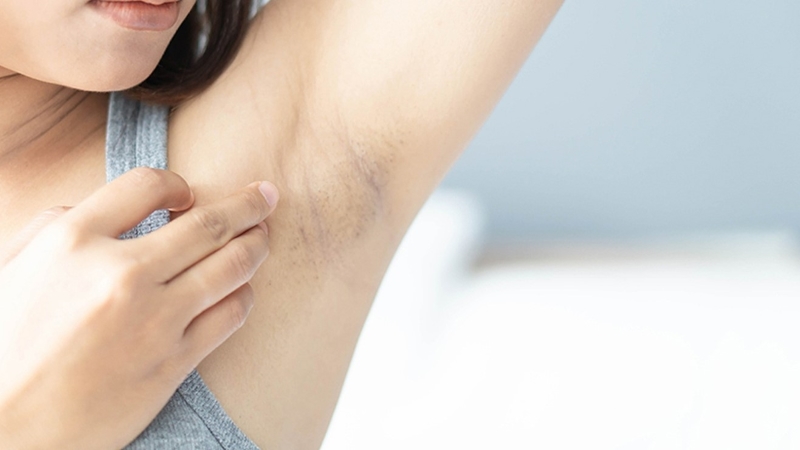 cách trị long nách cho tuổi dậy thì